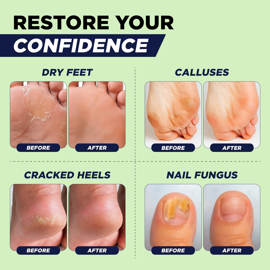 Tea Tree Callus Remover Gel & Foot Soak, Foot Cream for Dry Cracked Feet