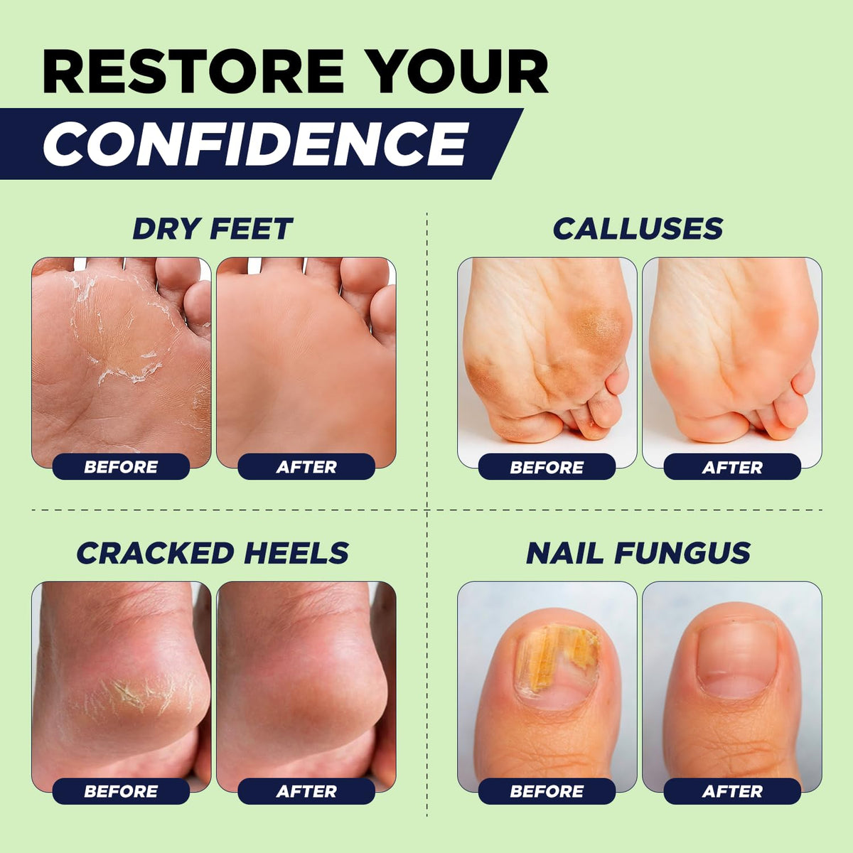 Tea Tree Callus Remover Gel & Foot Soak, Foot Cream for Dry Cracked Feet