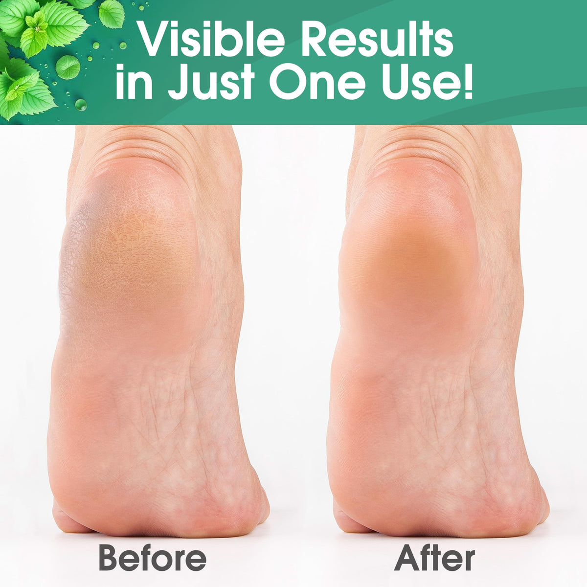 DeEnti Foot Callus Remover Gel, Dead Skin Remover for Feet, 8oz Cool Mint